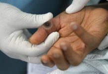 Thailand Laporkan Dugaan Kasus Pertama Mpox ‘Cacar Monyet’ Varian yang Lebih Parah