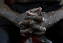 Makin Melonjak! Kasus Mpox di Afrika Nyaris Tembus 30 Ribu Kasus