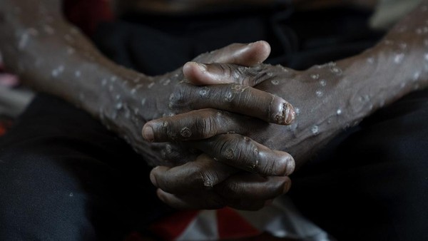 mpox-menyebar-cepat-di-kongo-kini-mencapai-17500-kasus-2_169