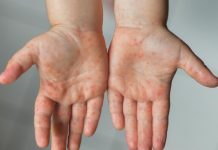 Kemenkes Minta Faskes Siapkan APD untuk Lindungi Nakes dari Campak