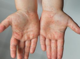 Kemenkes Minta Faskes Siapkan APD untuk Lindungi Nakes dari Campak