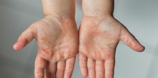 Kemenkes Minta Faskes Siapkan APD untuk Lindungi Nakes dari Campak