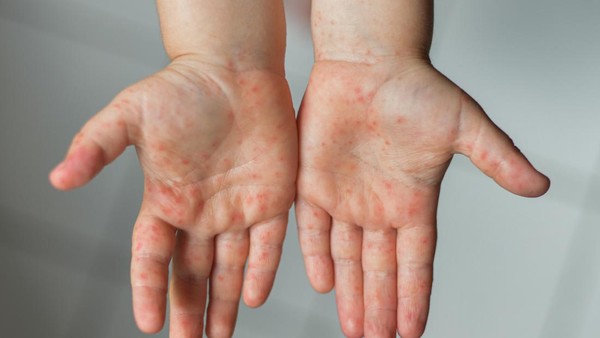 ilustrasi-campak_169