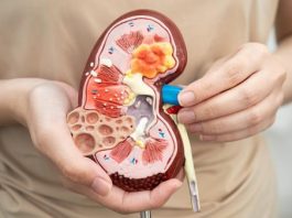 Gejala Kanker Ginjal yang Terlihat dari Urine, Waspadai Jika Mengalaminya