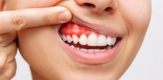 Dokter Ungkap Bahaya Gusi Berdarah, Bisa Berkaitan dengan Jantung hingga Diabetes