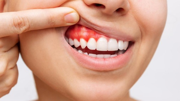 ilustrasi-radang-gusi-atau-gingivitis_169
